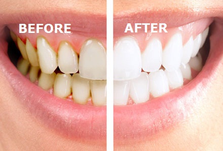 Scaling with polishing (cleaning your teeth)