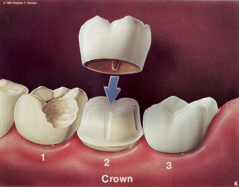 Minimally Invasive Cosmetic Filling (Light cure filling)