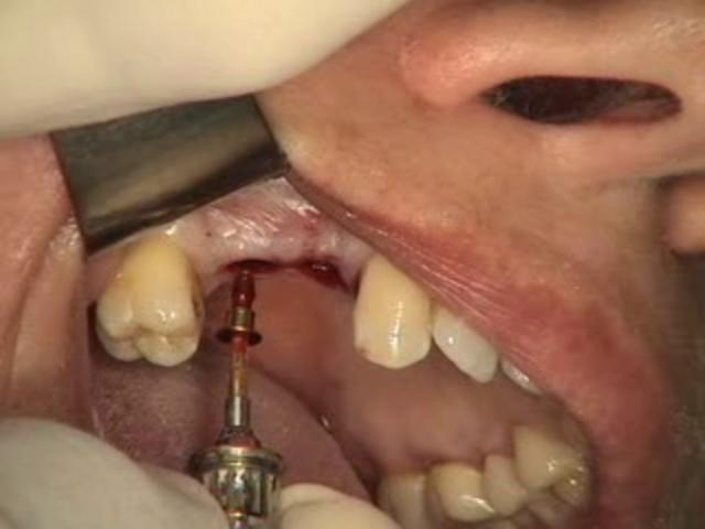 Root canal treatment (preserved tooth)